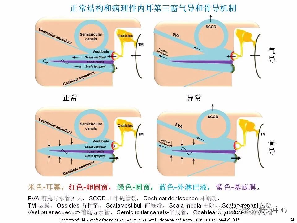 影像PPT - 耳硬化症中的“双环征”-32 影像PPT - 耳硬化症中的“双环征”-32
