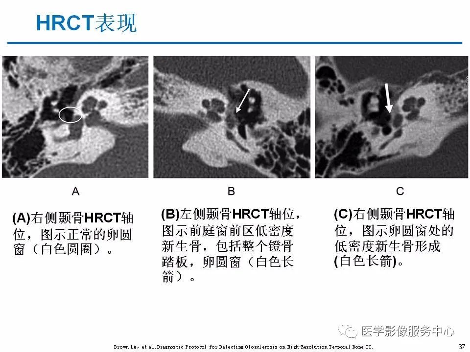 影像PPT - 耳硬化症中的“双环征”-35 影像PPT - 耳硬化症中的“双环征”-35