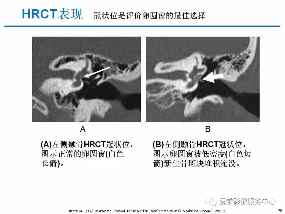 影像PPT - 耳硬化症中的“双环征”-36 影像PPT - 耳硬化症中的“双环征”-36