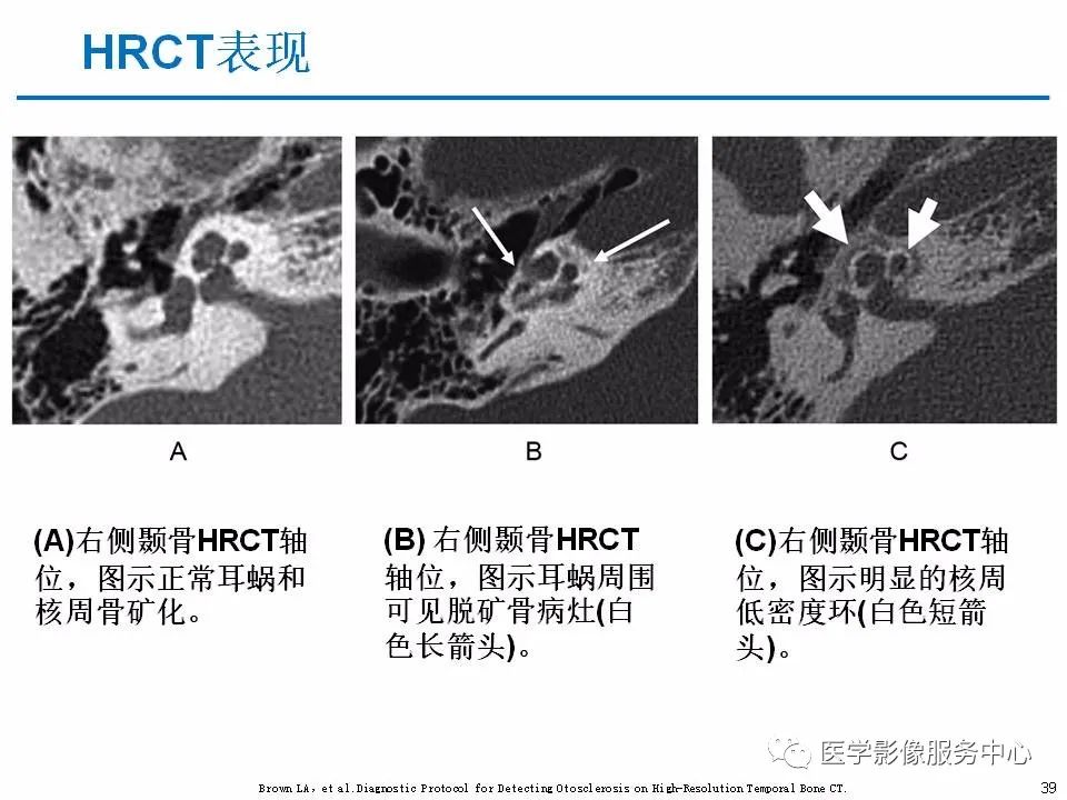 影像PPT - 耳硬化症中的“双环征”-37 影像PPT - 耳硬化症中的“双环征”-37