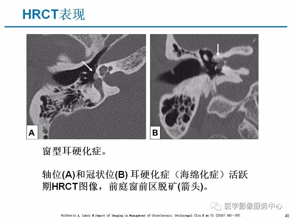 影像PPT - 耳硬化症中的“双环征”-38 影像PPT - 耳硬化症中的“双环征”-38