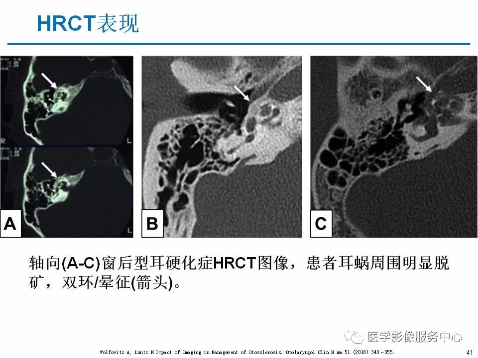 影像PPT - 耳硬化症中的“双环征”-39 影像PPT - 耳硬化症中的“双环征”-39