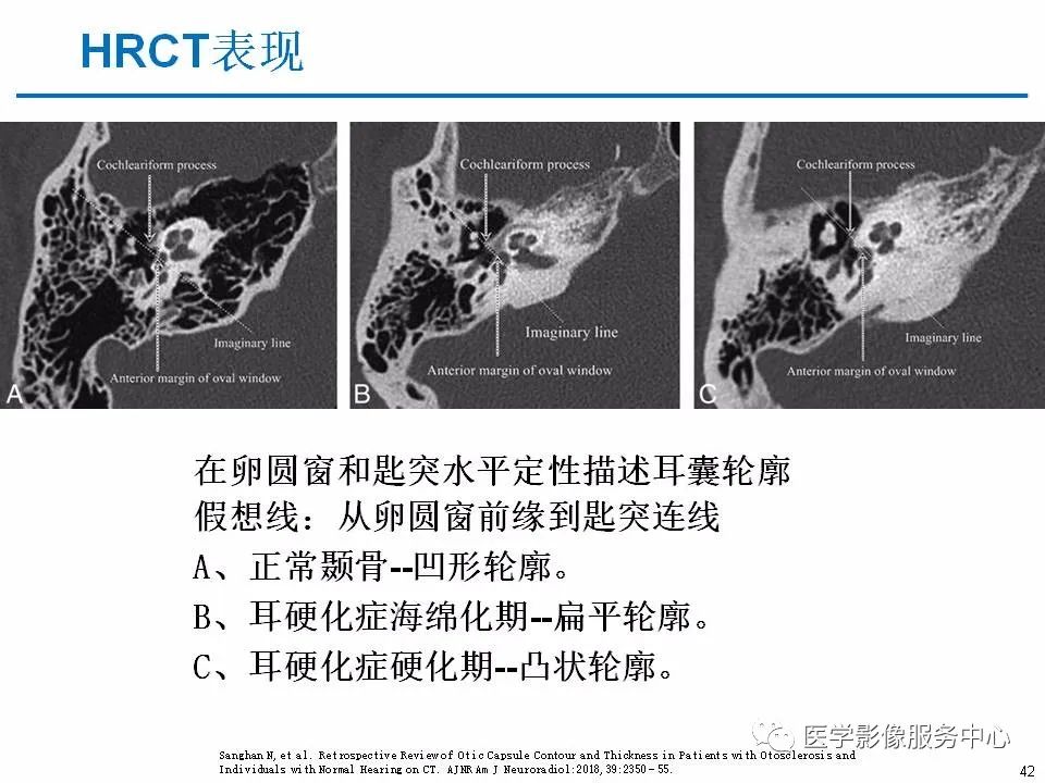 影像PPT - 耳硬化症中的“双环征”-40 影像PPT - 耳硬化症中的“双环征”-40