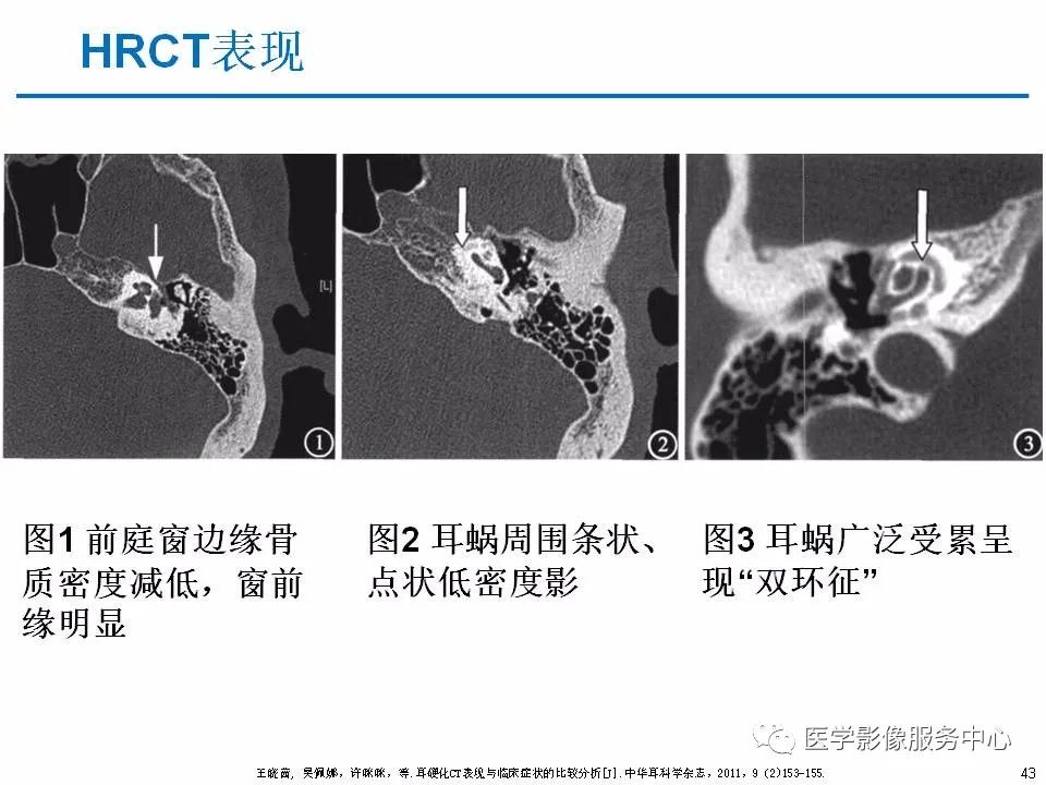 影像PPT - 耳硬化症中的“双环征”-41 影像PPT - 耳硬化症中的“双环征”-41
