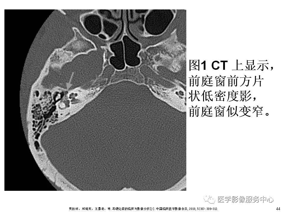 影像PPT - 耳硬化症中的“双环征”-42 影像PPT - 耳硬化症中的“双环征”-42