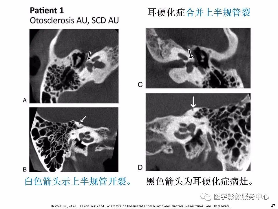 影像PPT - 耳硬化症中的“双环征”-45 影像PPT - 耳硬化症中的“双环征”-45