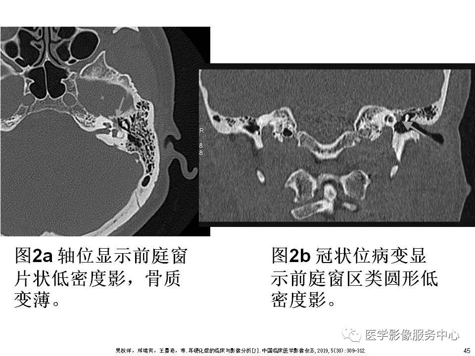 影像PPT - 耳硬化症中的“双环征”-43 影像PPT - 耳硬化症中的“双环征”-43