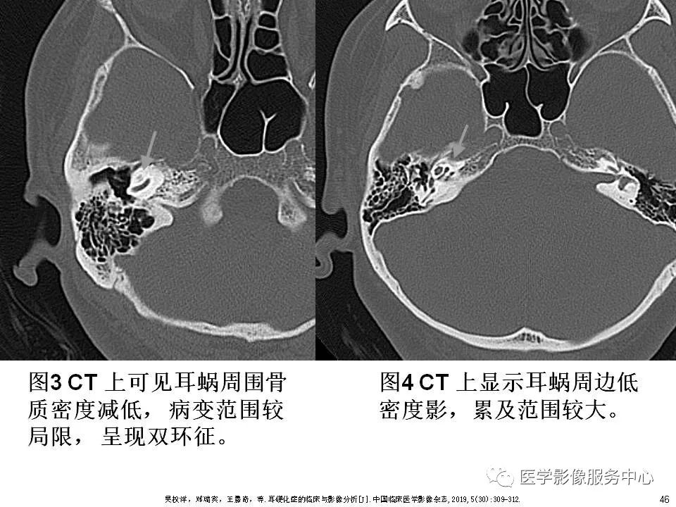 影像PPT - 耳硬化症中的“双环征”-44 影像PPT - 耳硬化症中的“双环征”-44