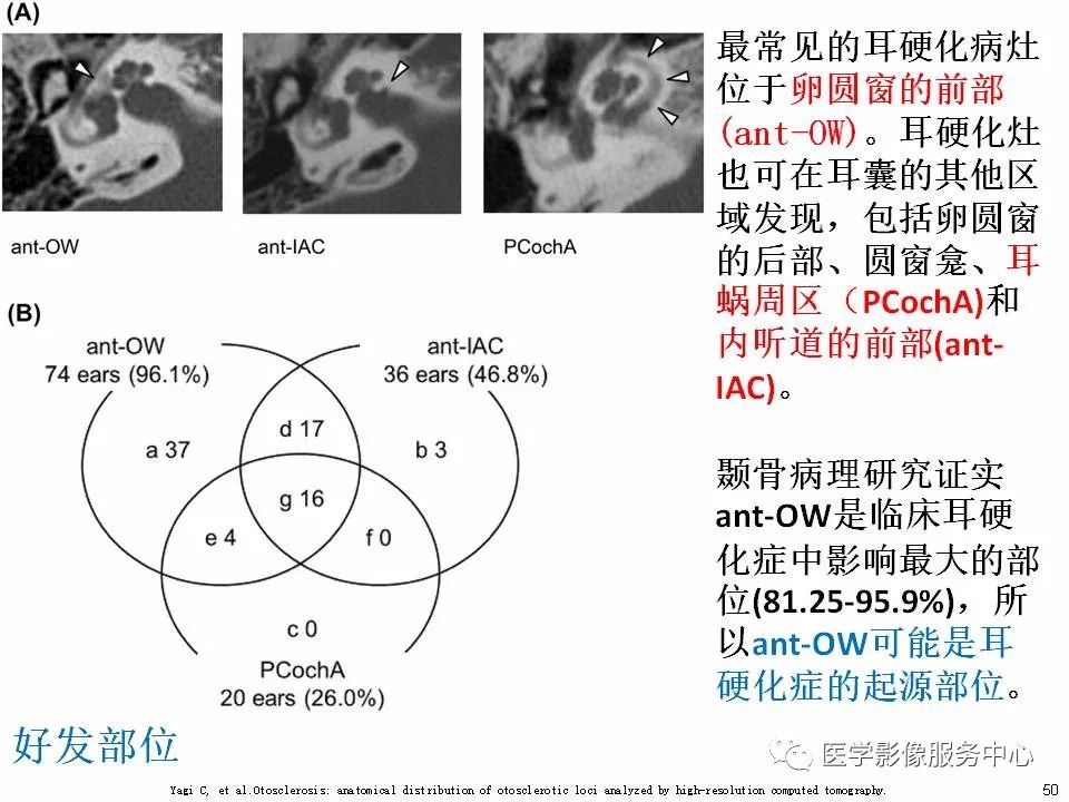 影像PPT - 耳硬化症中的“双环征”-48 影像PPT - 耳硬化症中的“双环征”-48