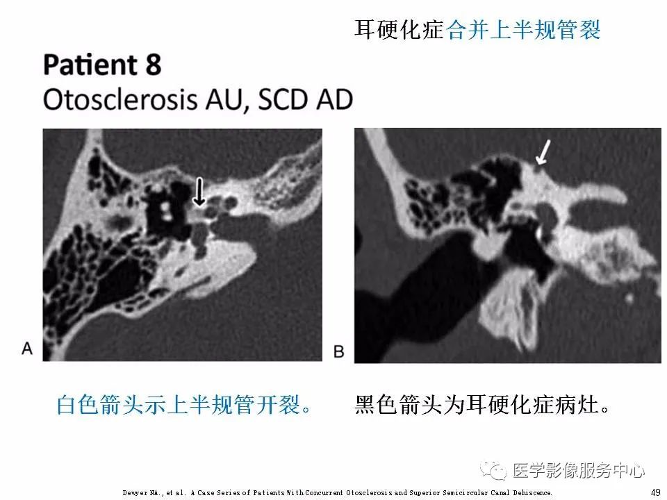 影像PPT - 耳硬化症中的“双环征”-47 影像PPT - 耳硬化症中的“双环征”-47