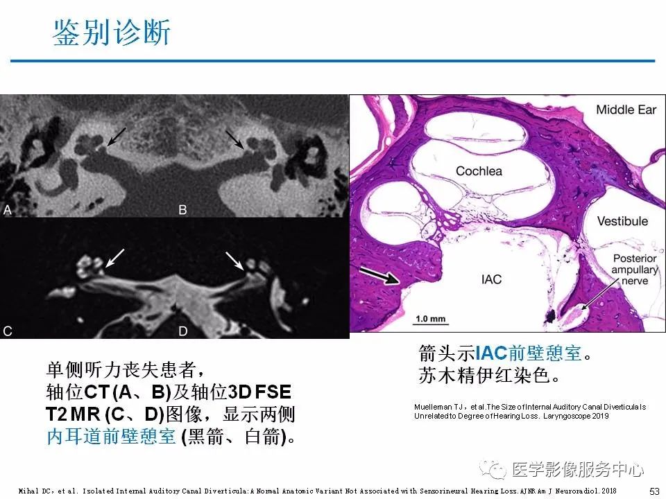 影像PPT - 耳硬化症中的“双环征”-51 影像PPT - 耳硬化症中的“双环征”-51