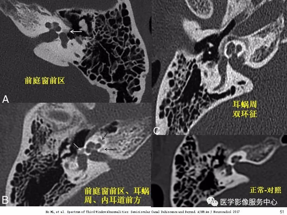 影像PPT - 耳硬化症中的“双环征”-49 影像PPT - 耳硬化症中的“双环征”-49