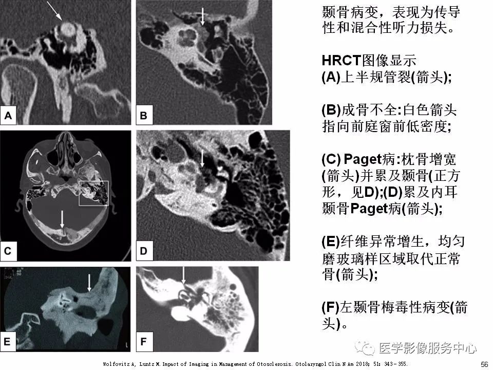 影像PPT - 耳硬化症中的“双环征”-54 影像PPT - 耳硬化症中的“双环征”-54