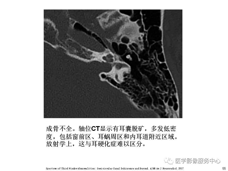 影像PPT - 耳硬化症中的“双环征”-53 影像PPT - 耳硬化症中的“双环征”-53