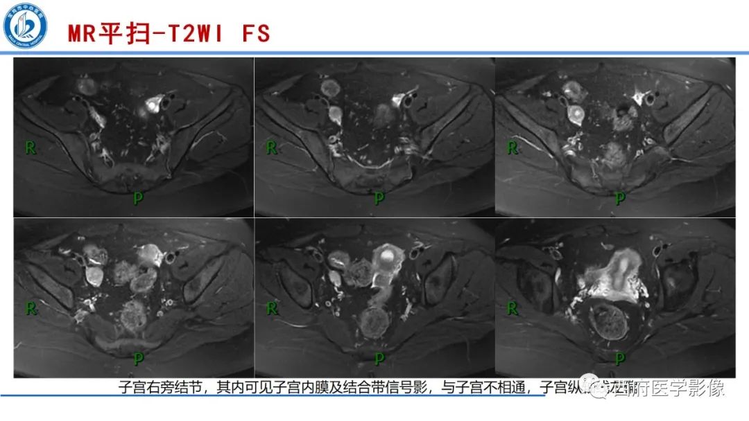 影像PPT - 【病例】多囊卵巢综合征1例MR影像诊断与鉴别-4
