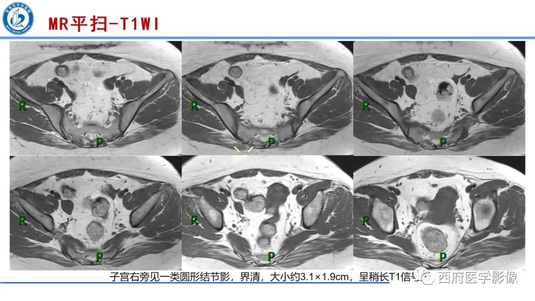 影像PPT - 【病例】多囊卵巢综合征1例MR影像诊断与鉴别-3