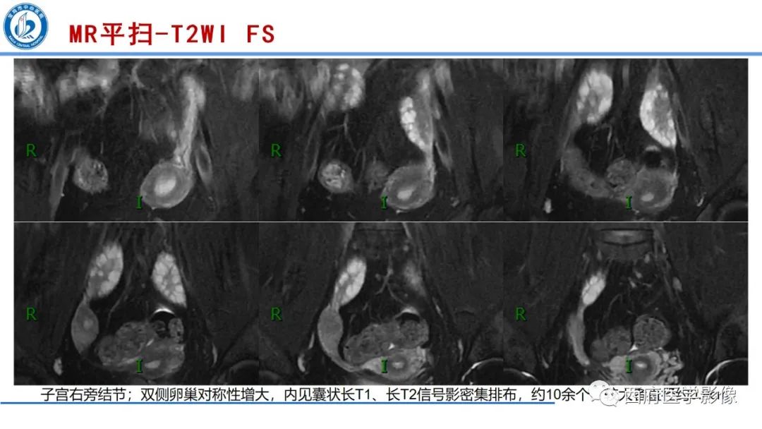 影像PPT - 【病例】多囊卵巢综合征1例MR影像诊断与鉴别-1