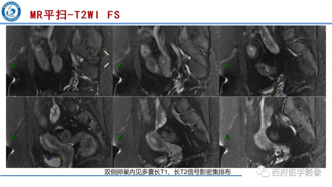 影像PPT - 【病例】多囊卵巢综合征1例MR影像诊断与鉴别-6