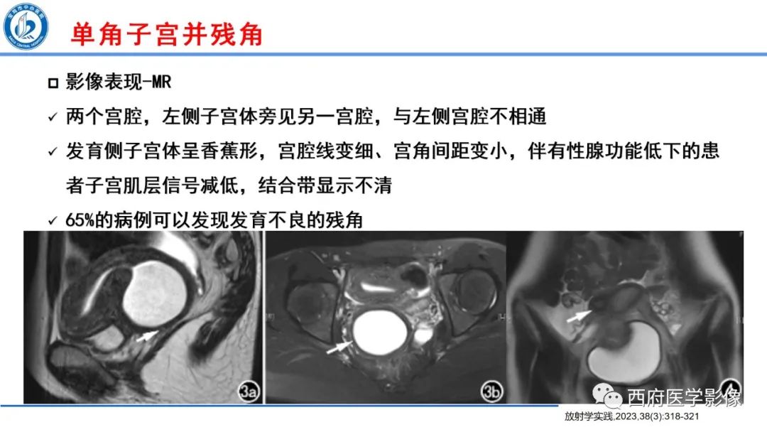 影像PPT - 【病例】多囊卵巢综合征1例MR影像诊断与鉴别-14