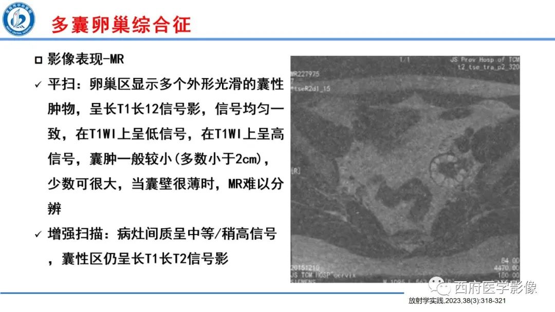 影像PPT - 【病例】多囊卵巢综合征1例MR影像诊断与鉴别-18
