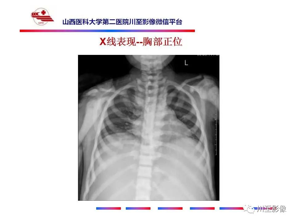 影像PPT - 【PPT】石骨症-6 影像PPT - 【PPT】石骨症-6