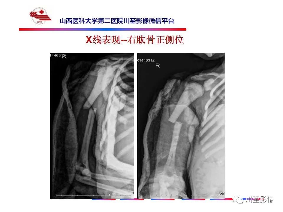 影像PPT - 【PPT】石骨症-7 影像PPT - 【PPT】石骨症-7