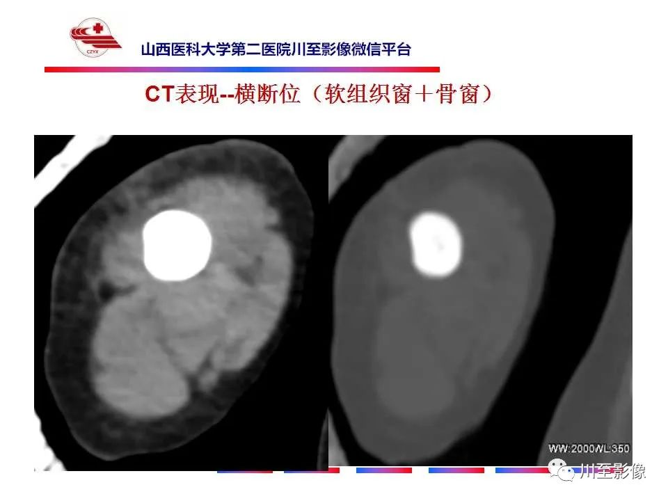 影像PPT - 【PPT】石骨症-9 影像PPT - 【PPT】石骨症-9