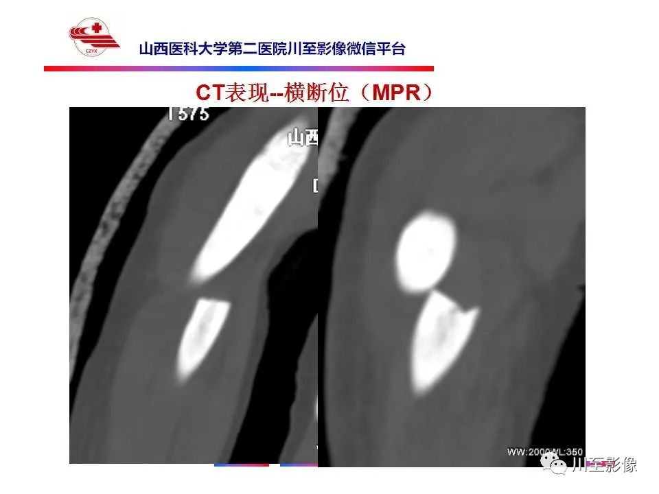 影像PPT - 【PPT】石骨症-10 影像PPT - 【PPT】石骨症-10