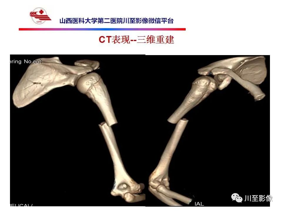 影像PPT - 【PPT】石骨症-11 影像PPT - 【PPT】石骨症-11