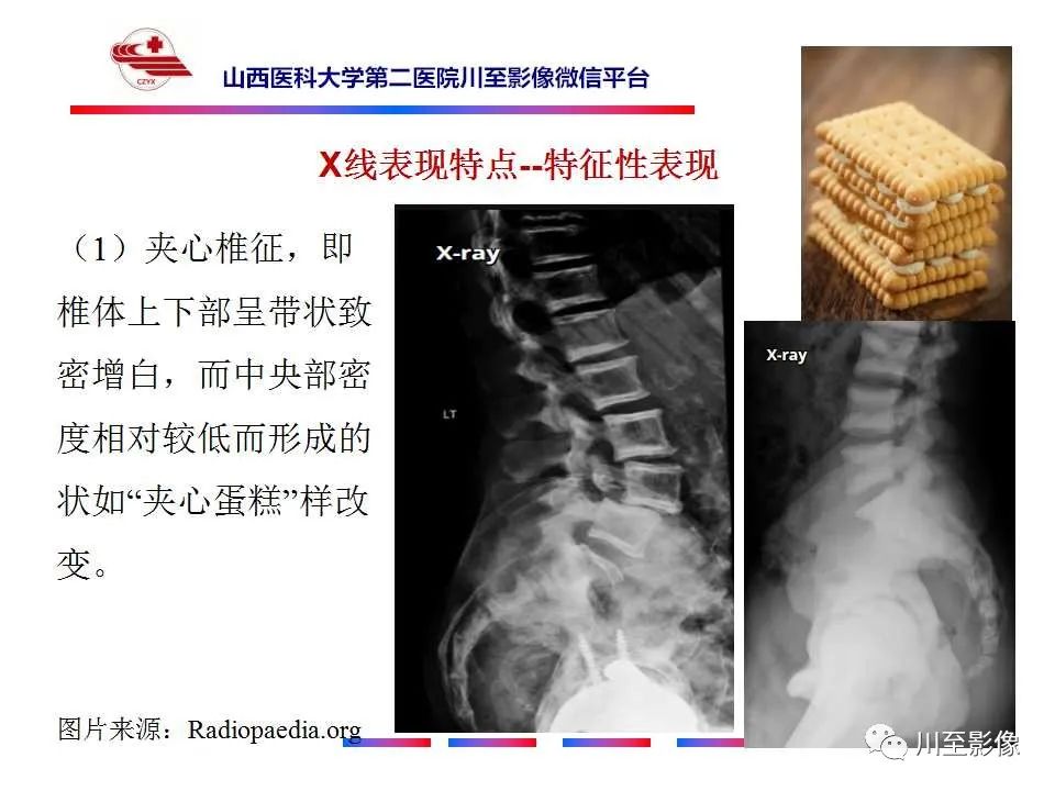 影像PPT - 【PPT】石骨症-19 影像PPT - 【PPT】石骨症-19