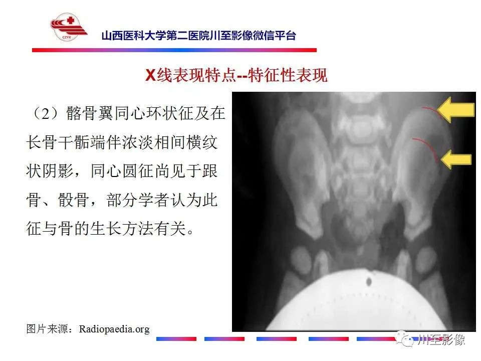 影像PPT - 【PPT】石骨症-20 影像PPT - 【PPT】石骨症-20