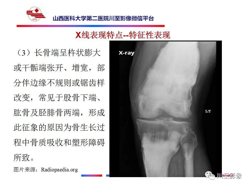 影像PPT - 【PPT】石骨症-21 影像PPT - 【PPT】石骨症-21