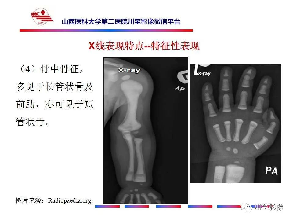 影像PPT - 【PPT】石骨症-22 影像PPT - 【PPT】石骨症-22