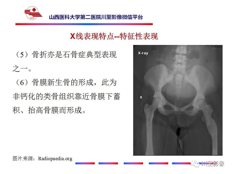 影像PPT - 【PPT】石骨症-23 影像PPT - 【PPT】石骨症-23