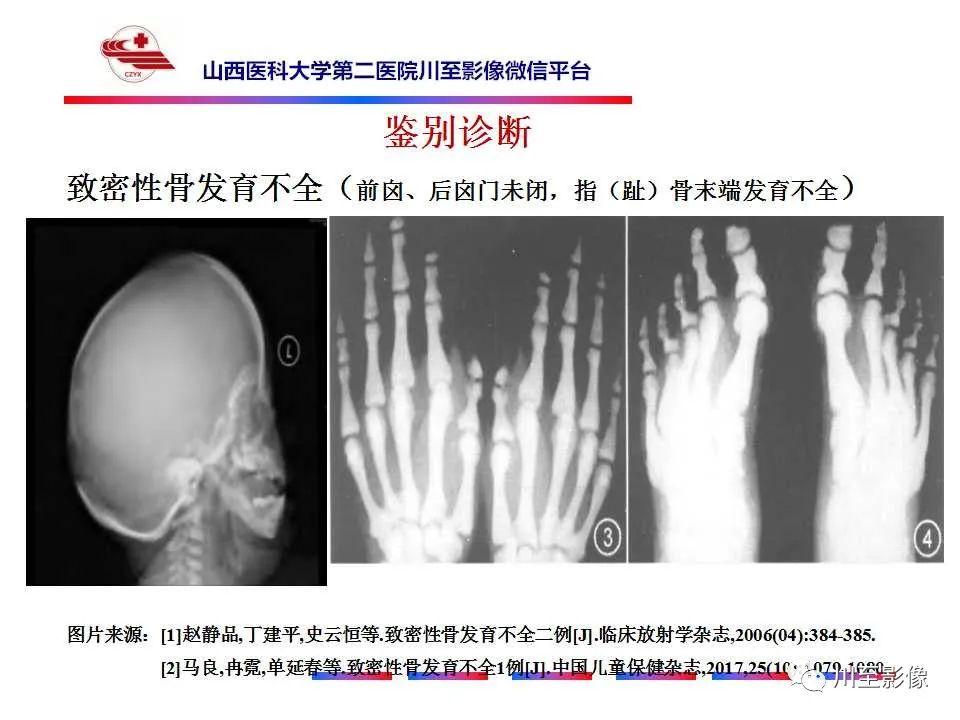 影像PPT - 【PPT】石骨症-25 影像PPT - 【PPT】石骨症-25