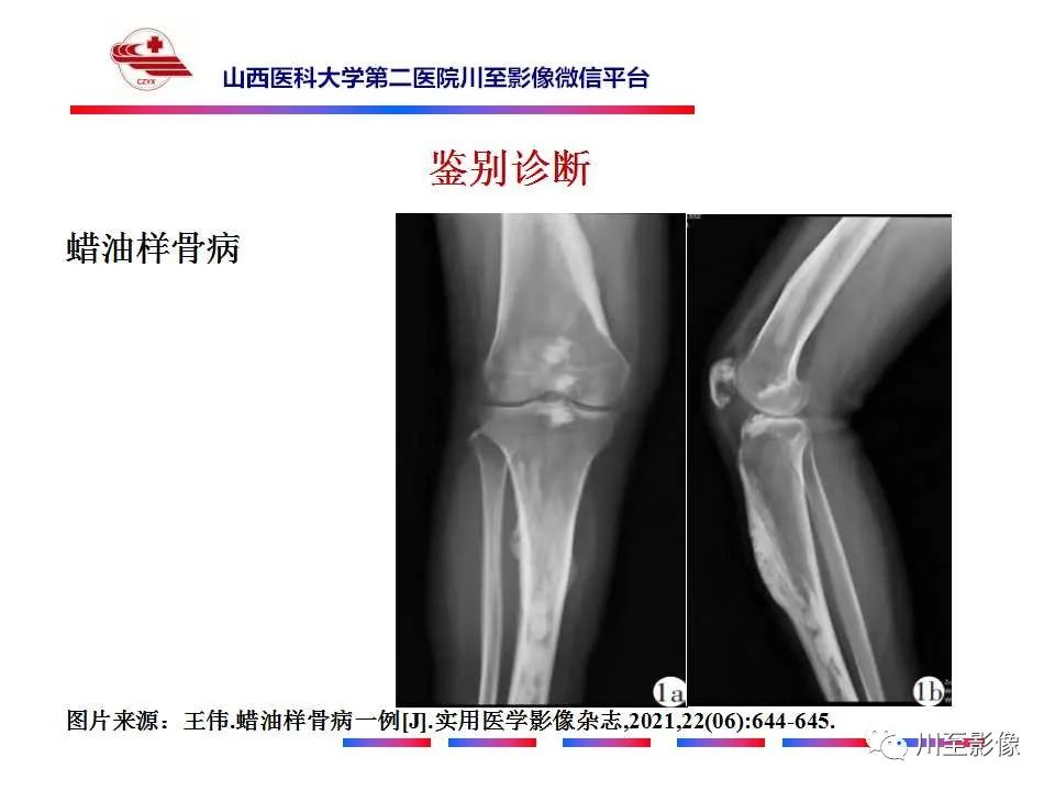 影像PPT - 【PPT】石骨症-31 影像PPT - 【PPT】石骨症-31