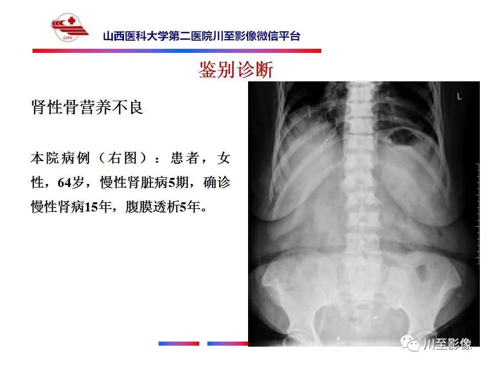影像PPT - 【PPT】石骨症-29 影像PPT - 【PPT】石骨症-29
