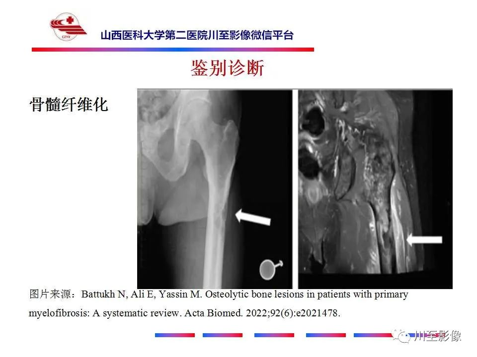 影像PPT - 【PPT】石骨症-33 影像PPT - 【PPT】石骨症-33