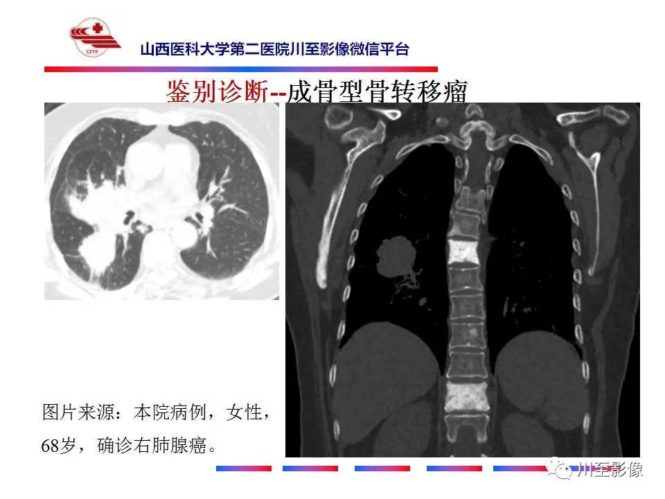 影像PPT - 【PPT】石骨症-35 影像PPT - 【PPT】石骨症-35