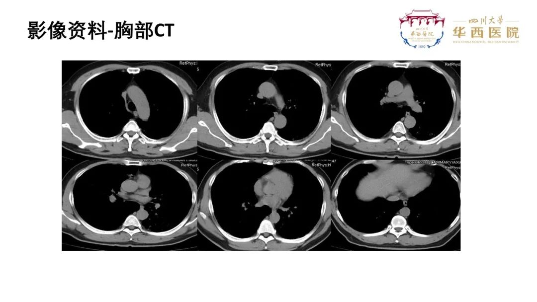 影像PPT - 【病例】肺泡蛋白沉积症1例CT影像-4