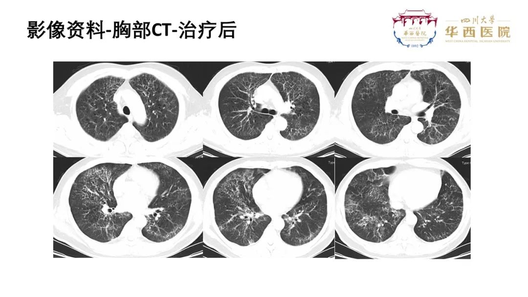 影像PPT - 【病例】肺泡蛋白沉积症1例CT影像-7
