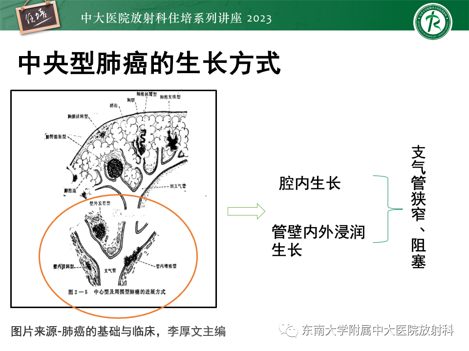 影像PPT - 【PPT】肺癌影像征象及病理分析-9