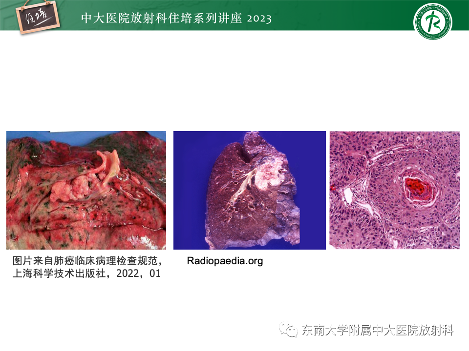 影像PPT - 【PPT】肺癌影像征象及病理分析-10