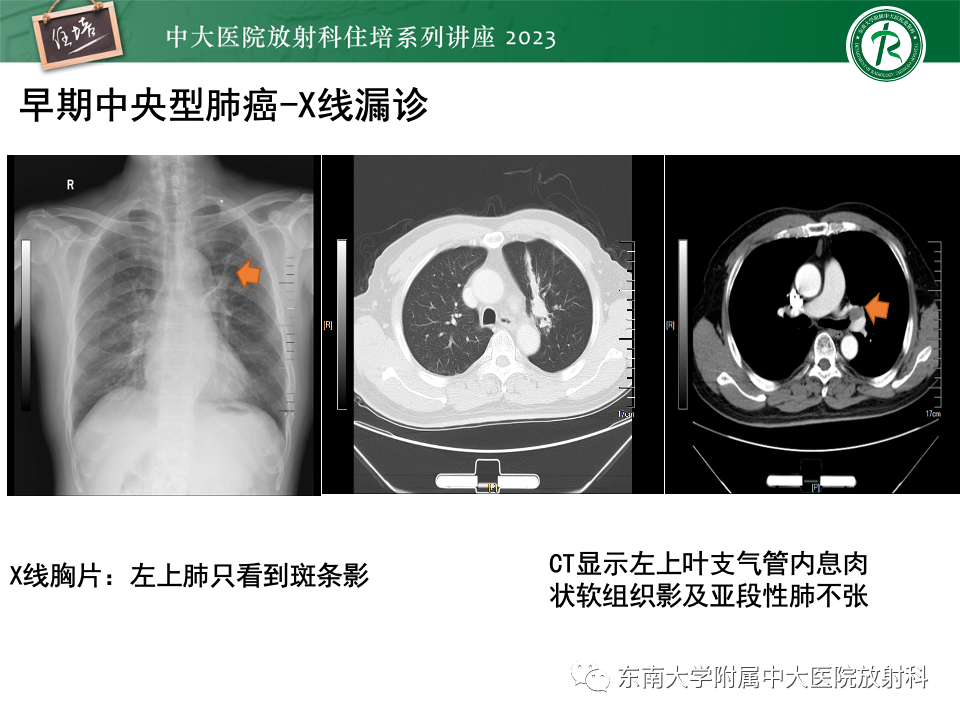 影像PPT - 【PPT】肺癌影像征象及病理分析-13
