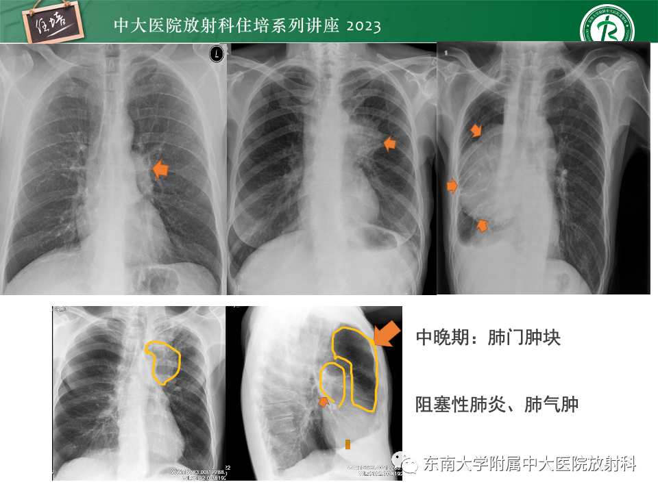 影像PPT - 【PPT】肺癌影像征象及病理分析-14