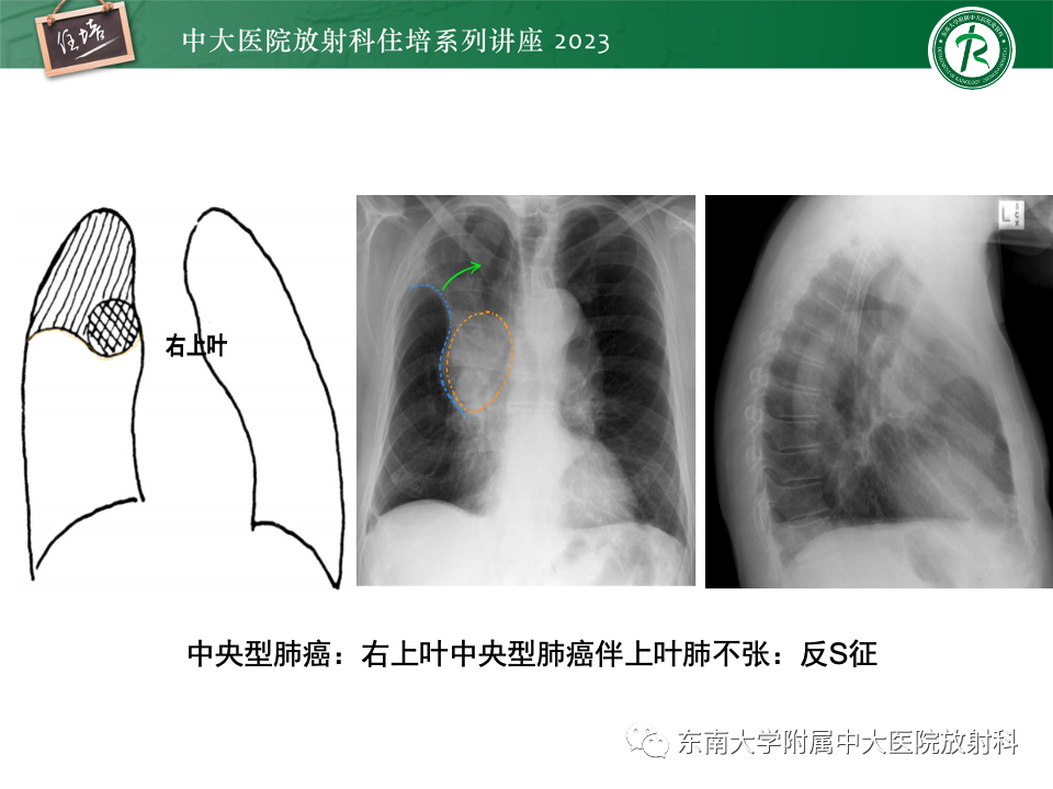 影像PPT - 【PPT】肺癌影像征象及病理分析-15