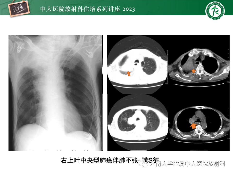 影像PPT - 【PPT】肺癌影像征象及病理分析-16