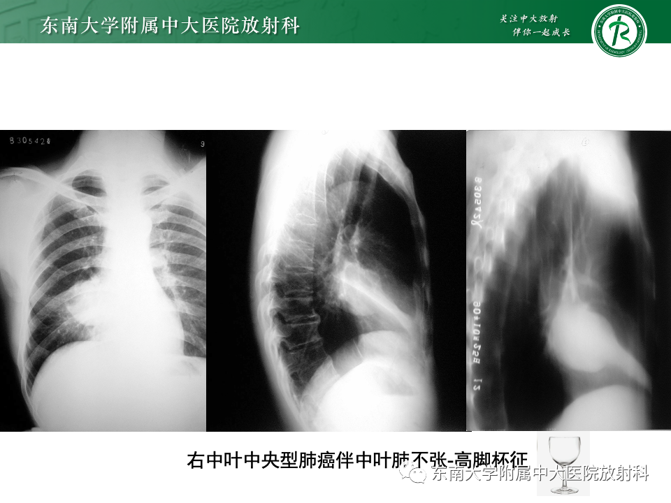 影像PPT - 【PPT】肺癌影像征象及病理分析-17
