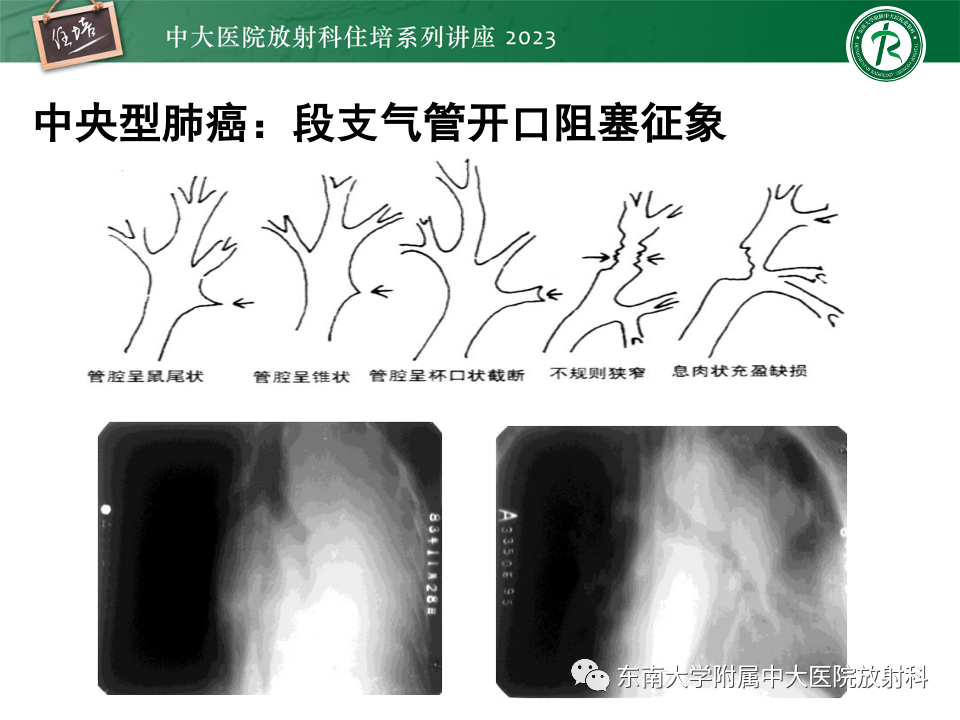 影像PPT - 【PPT】肺癌影像征象及病理分析-18