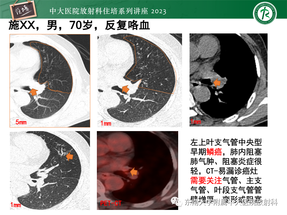 影像PPT - 【PPT】肺癌影像征象及病理分析-20